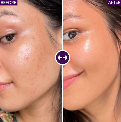 B-Boost Kojic Acid Glow Pads - Clear Skin in 7 Days